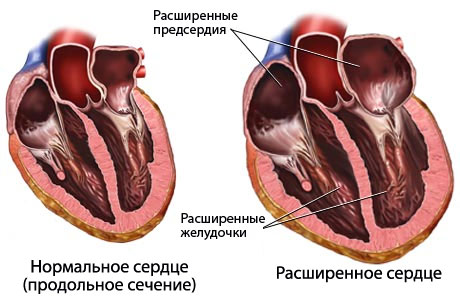 Гипертрофическая кардиомиопатия – современные перспективные методы лечения